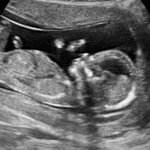   وضعیت جنین در هفته سیزدهم بارداری