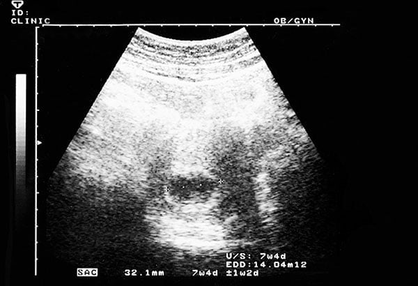 علائم نیازمند مراجعه به پزشک در هفته هفتم بارداری
